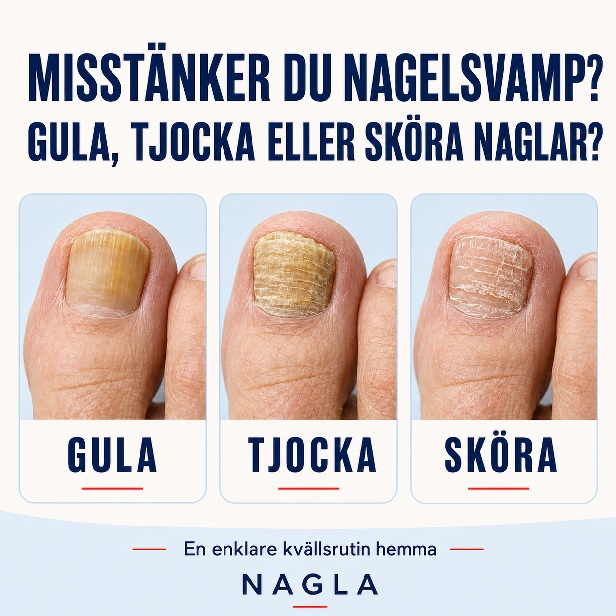 Misstänker du nagelsvamp? Gula, tjocka eller sköra naglar